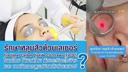 รักษาหลุมสิวด้วยเลเซอร์ Fractional Carbon Dioxide CO2 Laser (FxCO2) ในคนไทย ได้ผลดีไหม ต้องระวังอะไรบ้าง และ เทคนิคการดูแลผิวหลังทำเลเซอร์ ?
